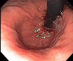 Hiatal Hernia Retroflexed