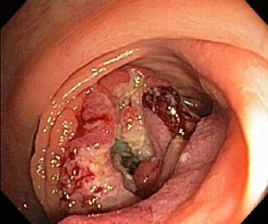 Advanced colon cancer