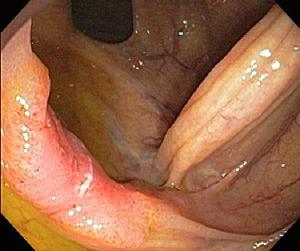 Early colon cancer