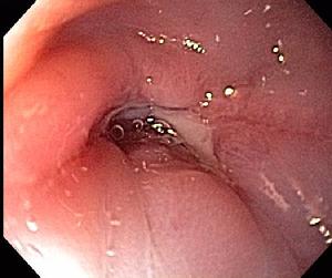 Esophageal Stricture with Ulceration