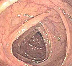 Normal colon