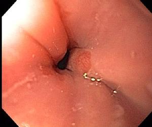 Normal Esophagogastric Junction