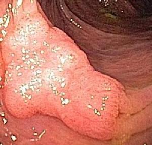 Flat polyp