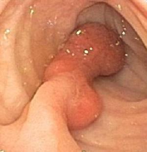 Pedunculated polyp