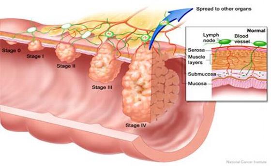 Stages of colon cancer