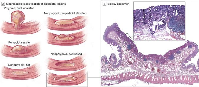 Adenoma classification